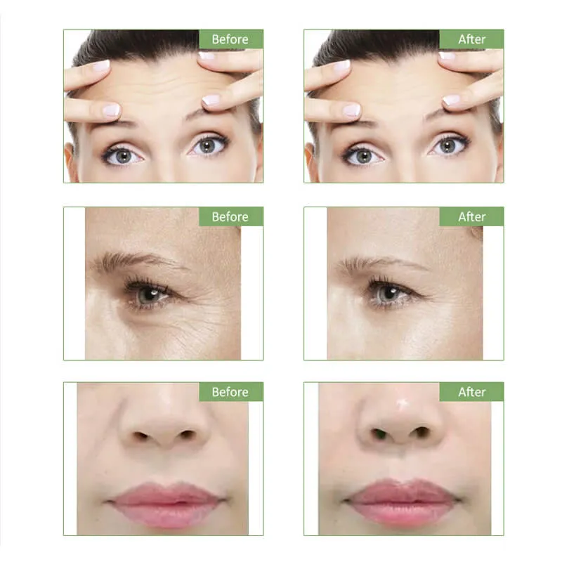 Radio Frequency Infrared Dot Matrix Lifting Facial Lifting Machine Anti Aging